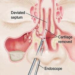 nose surgery